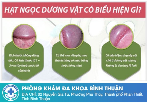 Hạt ngọc dương vật mọc ở đâu? Dấu hiệu nhận biết 