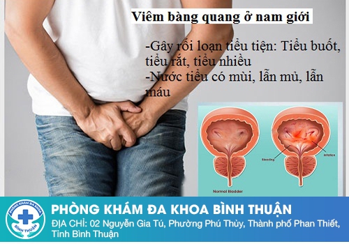 Triệu chứng viêm bàng quang