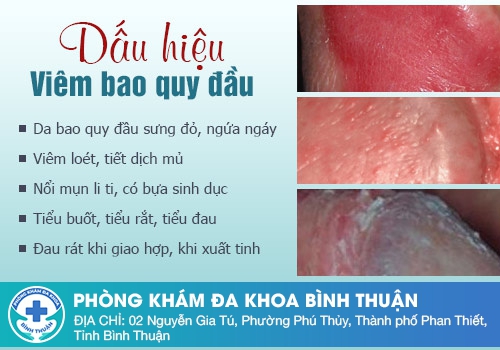 Những bệnh bao quy đầu thường gặp ở nam giới