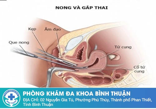 Nong và gắp thai 