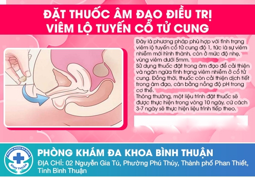 Cách chữa trị viêm lộ tuyến cổ tử cung