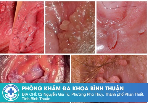 Hôi âm đạo do các bệnh xã hội