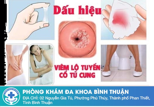 Khí hư màu trắng đục có mùi hôi do viêm lộ tuyến cổ tử cung