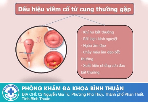  Khí hư màu trắng đục như bã đậu do viêm cổ tử cung