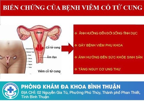 Viêm cổ tử cung và những biến chứng nguy hiểm　