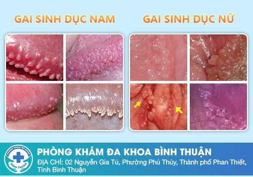 Nổi mụn thịt vùng kín nữ do gai sinh dục