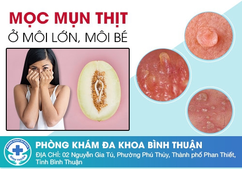 Bệnh mụn rộp sinh dục gây nổi mụn ở vùng kín nữ