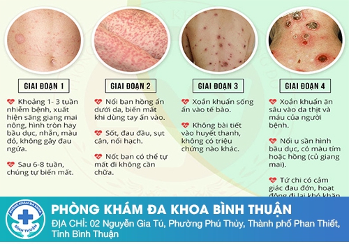 Nổi mụn cứng vùng kín không đau ở nữ giới là bệnh gì?