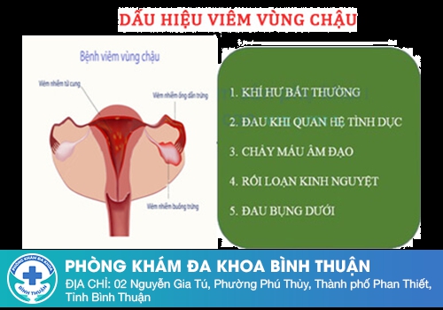 Ra khí hư như bã đậu do bệnh viêm vùng chậu