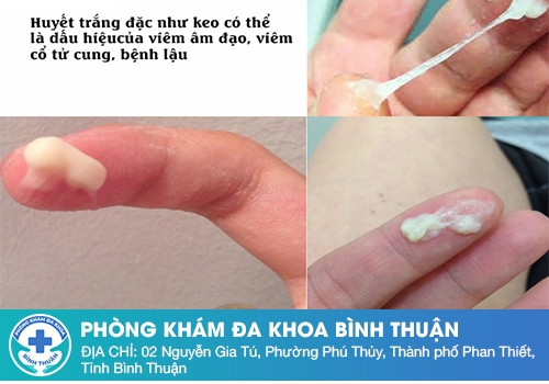 Ra khí hư màu trắng đục là bị gì?