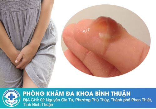 Chua âm đạo biểu hiện của những bệnh lý gì?