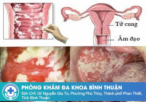 Dịch âm đạo màu trắng sữa có sao không?