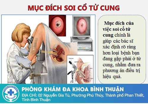 Mục đích của việc soi cổ tử cung