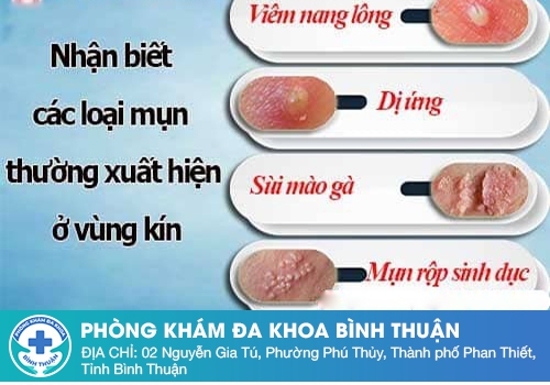 Nổi mụn cứng vùng kín không đau ở nữ giới là bệnh gì?