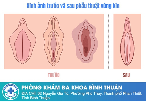 Chỉnh âm đạo bao lâu thì lành?