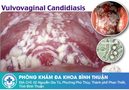 Khí hư màu trắng vón cục như bã đậu – Nhiễm nấm âm đạo 