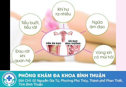 Khí hư màu trắng đục như sữa chua do viêm âm đạo