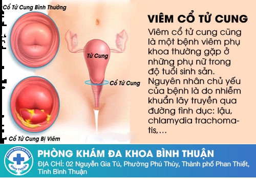 Chua âm đạo do viêm cổ tử cung