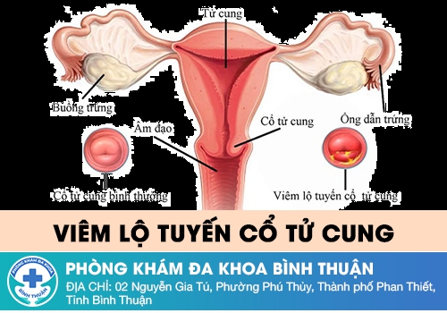 Viêm lộ tuyến cổ tử cung là gì?