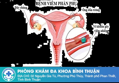 Khí hư màu trắng đục và ngứa do viêm phần phụ