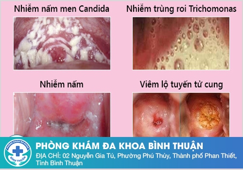 Nguyên nhân dẫn đến tình trạng huyết trắng bột