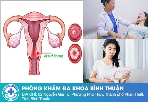 Vì sao chậm kinh? Viêm cổ tử cung có gây chậm kinh không?