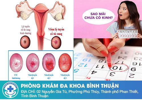 Viêm cổ tử cung có gây chậm kinh không?