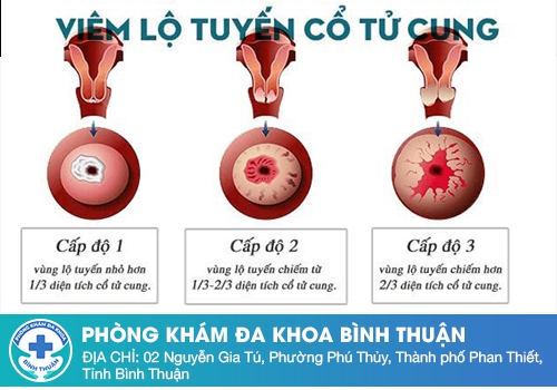 Hôi âm đạo do viêm lộ tuyến cổ tử cung