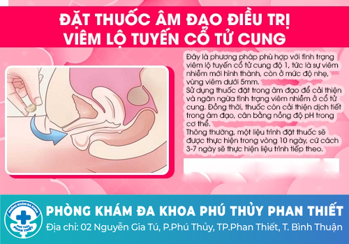 Cách chữa trị viêm lộ tuyến cổ tử cung