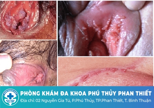 Thuốc bôi sùi mào gà có điều trị dứt điểm được không?