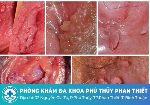 Hôi âm đạo do các bệnh xã hội