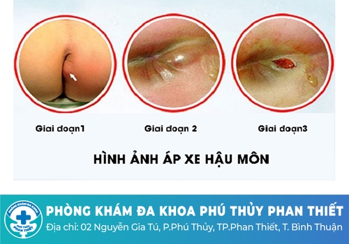 Triệu chứng áp xe hậu môn như thế nào?