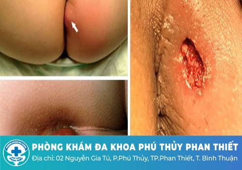 Chi phí mổ áp xe hậu môn bao nhiêu?