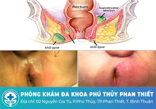 Dấu hiệu nhận biết nhanh áp xe hậu môn