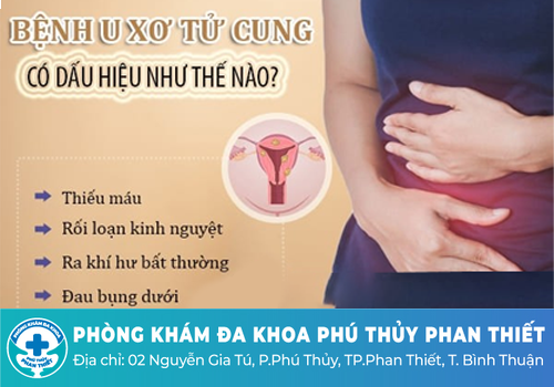 Khí hư màu trắng đục do u xơ tử cung