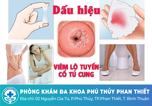 Khí hư màu trắng đục có mùi hôi do viêm lộ tuyến cổ tử cung