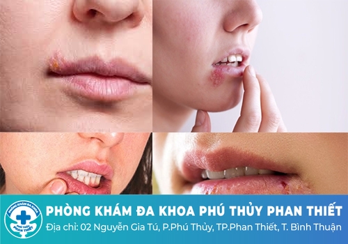 Mụn Herpes ở môi - miệng là gì?