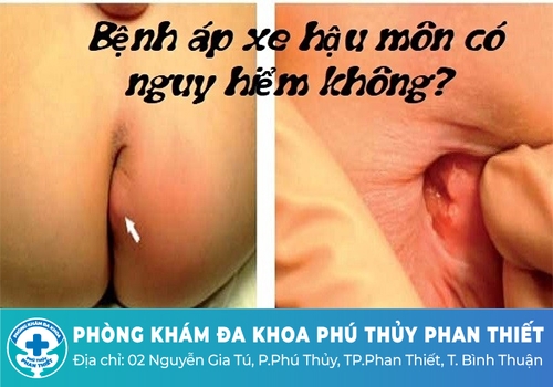 Đau nhức hậu môn không điều trị có nguy hiểm không?