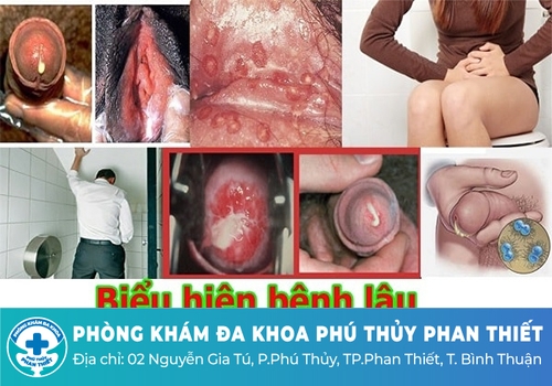 Chi phí điều trị bệnh lậu bao nhiêu tiền?