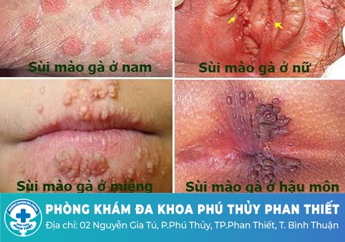 Giai đoạn phát triển của bệnh sùi mào gà