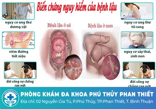Bệnh lây nhiễm qua đường tình dục