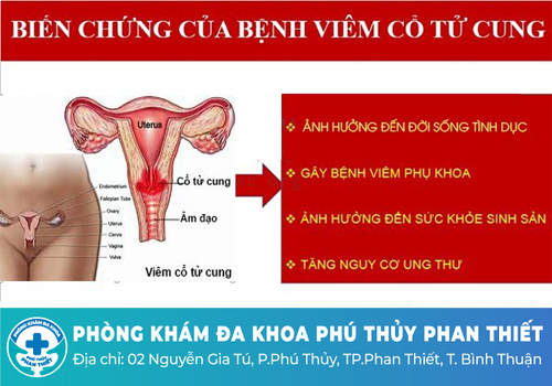 Viêm cổ tử cung và những biến chứng nguy hiểm　