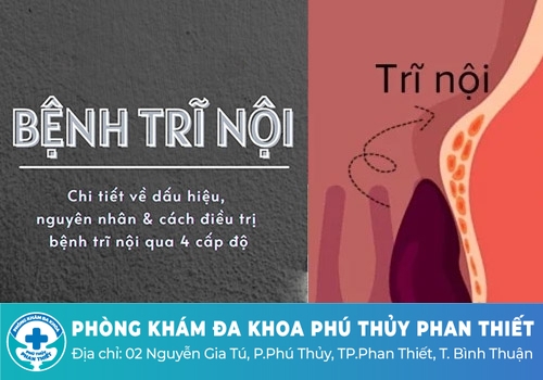 Tổng quan về bệnh trĩ nội