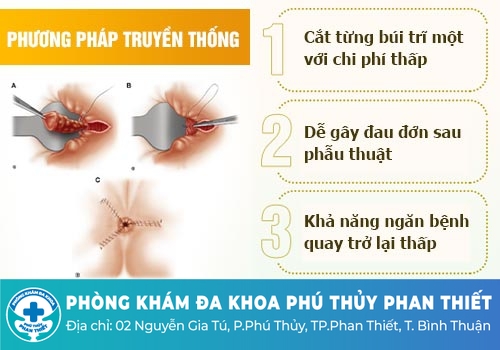 Thắt trĩ truyền thống