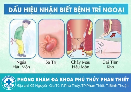 Các dấu hiệu dễ nhận biết sa búi trĩ sau sinh