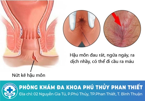Triệu chứng của bệnh rách hậu môn