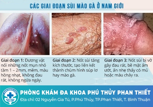 Dấu hiệu bệnh sùi mào gà ở nam giới