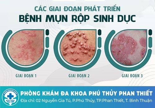 Mọc mụn nước âm đạo do bệnh mụn rộp sinh dục