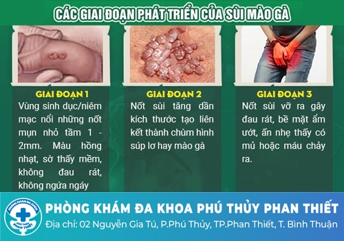 Giai đoạn phát triển của bệnh sùi mào gà