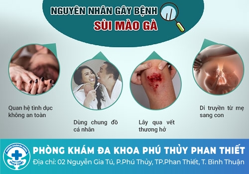 Nguyên nhân gây bệnh sùi mào gà ở nam giới
